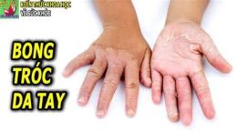 ảnh chụp màn hình bàn tay bị khô và bong da