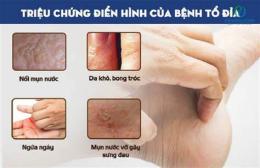 ảnh chụp màn hình bị bong da tay chân là bệnh gì