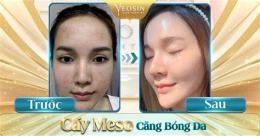 ảnh chụp màn hình cấy căng bóng da