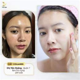 ảnh chụp màn hình cấy collagen căng bóng da