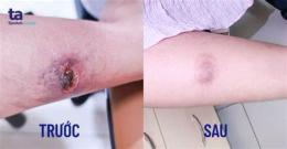 ảnh chụp màn hình da bị bỏng rát