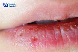ảnh chụp màn hình da bị bong tróc là bị gì