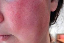 ảnh chụp màn hình da bị đỏ ngứa bong tróc