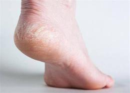 ảnh chụp màn hình da gót chân bị bong tróc