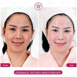 ảnh chụp màn hình liệu trình mesotherapy trẻ hóa căng bóng da