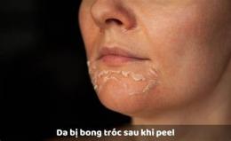 ảnh chụp màn hình peel da bong tróc