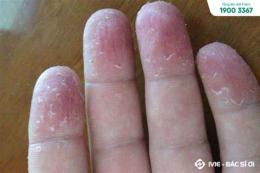 ảnh chụp màn hình tay bị khô da bong tróc