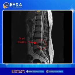 ảnh chụp màn hình thoát vị đĩa đệm có đá bóng được không