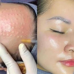 ảnh chụp màn hình tiêm căng bóng da meso
