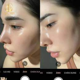 ảnh chụp màn hình tiêm căng bóng da