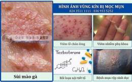 ảnh chụp màn hình vùng kín bị khô bong da
