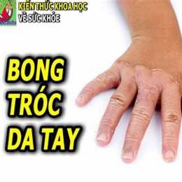 bệnh bong da tay