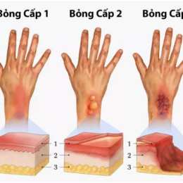 bị bỏng lột da phải làm sao