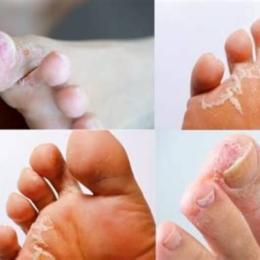 bong da bàn chân là bệnh gì