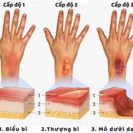 bỏng dạ bôi thuốc gì