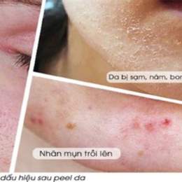 chăm sóc da sau peel không bong tróc