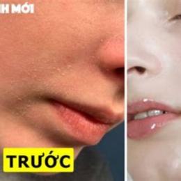 da bong tróc mùa đông