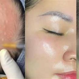 da căng bóng ngậm nước