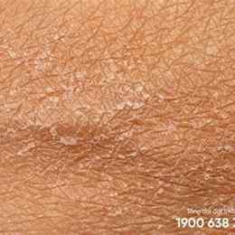 da chân bị bong tróc là bệnh gì