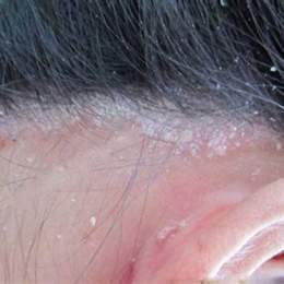 da đầu bị bong tróc vảy trắng