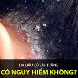 da đầu bị ngứa và bong vảy