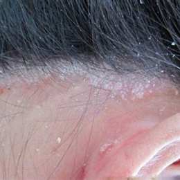 da đầu khô bong tróc ngứa