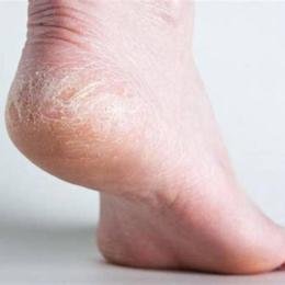da gót chân bị bong tróc