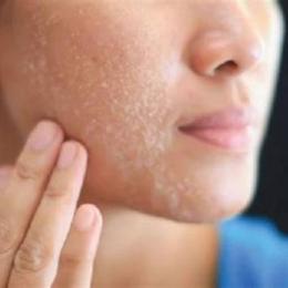 da mặt bị khô và bong tróc