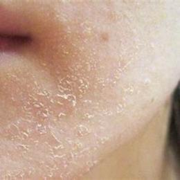 da mặt khô bong tróc ngứa rát