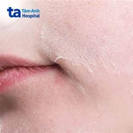 da mặt khô sần sùi bong tróc