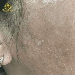 da mũi bị bong tróc