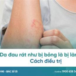 da rát như bị bỏng