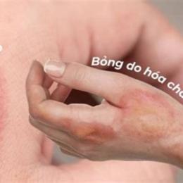 da tự nhiên bị bỏng rát