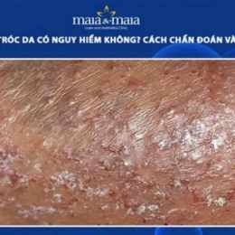 đầu dương vật bị bong da là bệnh gì