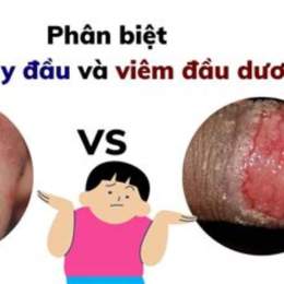 đầu dương vật bị ngứa và bong da