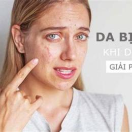 dùng retinol bị bong da nên làm gì
