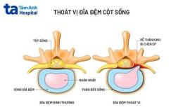 giao diện app thoát vị đĩa đệm có đá bóng được không