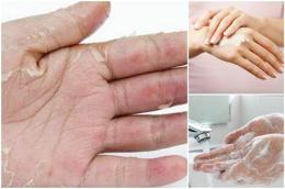 hướng dẫn sử dụng bị bong da tay chân là bệnh gì