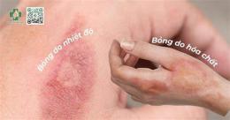 hướng dẫn sử dụng bị bỏng lột da phải làm sao