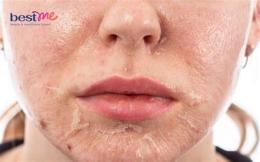 hướng dẫn sử dụng bỏng da mặt