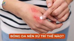 hướng dẫn sử dụng bỏng da nên làm gì