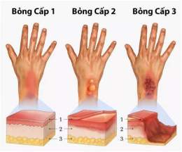 hướng dẫn sử dụng da bị bỏng rát