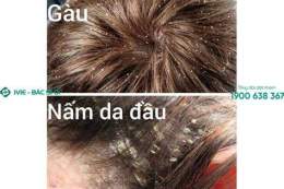 hướng dẫn sử dụng da đầu bị bong tróc vảy trắng
