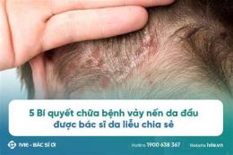 hướng dẫn sử dụng da đầu bị ngứa và bong vảy