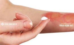 hướng dẫn sử dụng da tự nhiên bị bỏng rát