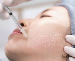 hướng dẫn sử dụng tiêm căng bóng trẻ hoá da