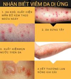 hướng dẫn sử dụng viêm da bọng nước