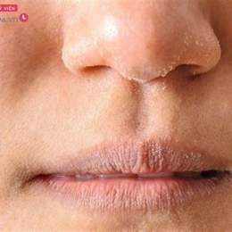 mặt bị bong tróc da