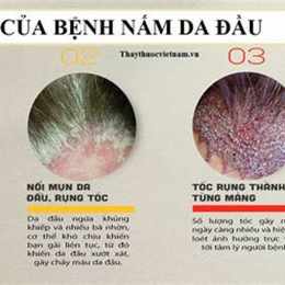 nguyên nhân bị bong da tay