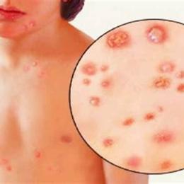 nổi bóng nước trên da là bệnh gì